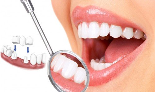Chăm sóc răng miệng sau khi làm răng sứ thẩm mỹ có cầu kỳ không?