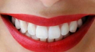 Sau khi bọc răng sứ có ngay ra tình trạng hôi miệng không?