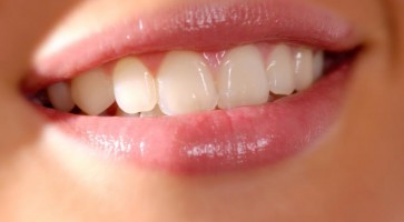 Veneer và Bọc răng sứ so sánh sự khác nhau