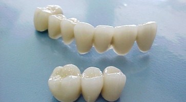 răng sứ nhật